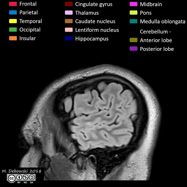 File:Brain lobes - annotated MRI (Radiopaedia 61691-69700 Sagittal 5).JPG