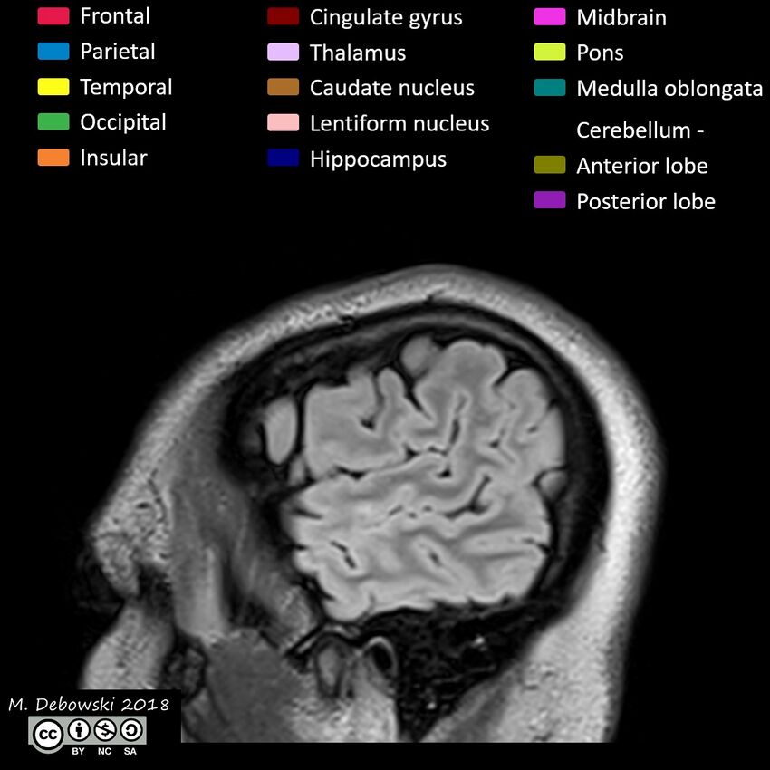 Brain lobes - annotated MRI (Radiopaedia 61691-69700 Sagittal 5).JPG