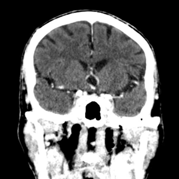 File:Brain metastases from lung cancer (Radiopaedia 27849-28092 Coronal C+ delayed 26).jpg