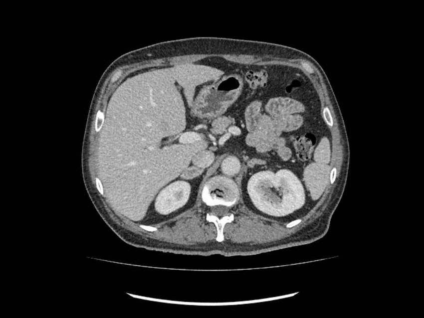Brain metastases from renal cell carcinoma (Radiopaedia 42222-45328 B 42).jpg