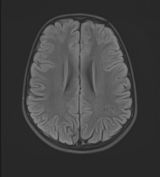 File:Brainstem glioma (Radiopaedia 70548-80674 Axial FLAIR 17).jpg