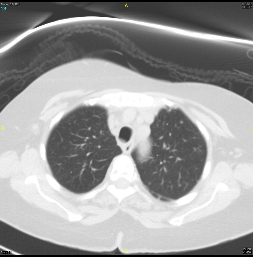 Breast primary with lung and bone metastases (Radiopaedia 40620-43228 Axial lung window 13).jpg