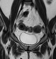 Broad ligament leiomyoma (Radiopaedia 81634-95516 Coronal T2 6).jpg