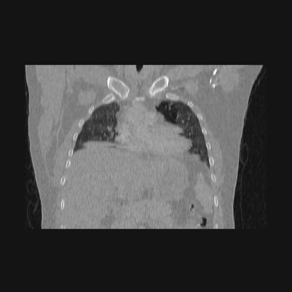 File:Bronchial atresia (Radiopaedia 60685-68439 Coronal lung window 48).jpg