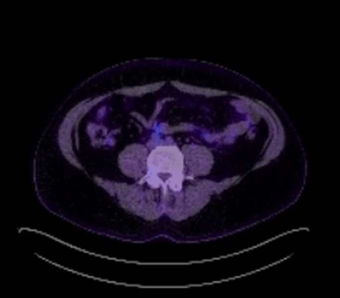 File:Bronchial carcinoid tumor (Radiopaedia 67377-76766 18FDG-PET-CT 50).jpg