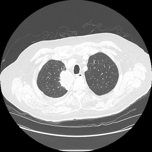 File:Bronchogenic adenocarcinoma and pulmonary embolism (Radiopaedia 9097-9806 Axial lung window 5).jpg