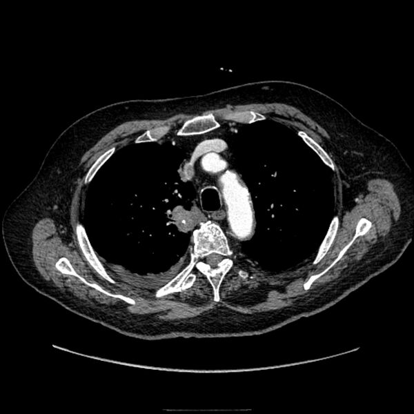 File:Bronchogenic adenocarcinoma and pulmonary embolism (Radiopaedia 9097-9806 D 20).jpg