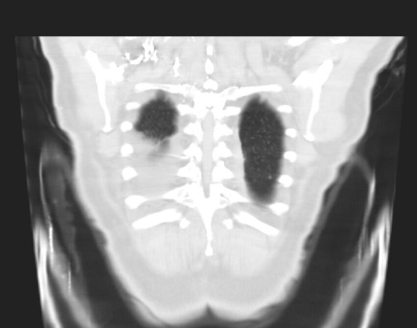 Bronchogenic carcinoma with lymphangitic spread (Radiopaedia 29002-29357 Coronal lung window 67).jpg