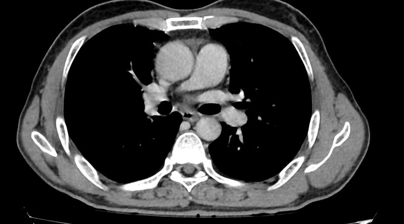 File:Bronchogenic carcinoma with superior vena cava syndrome (Radiopaedia 36497-38054 Axial C+ delayed 47).jpg