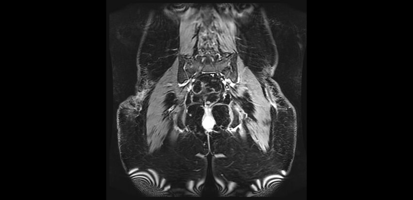 Buttock filler complications (Radiopaedia 63497-72115 Coronal T1 C+ 38).jpg