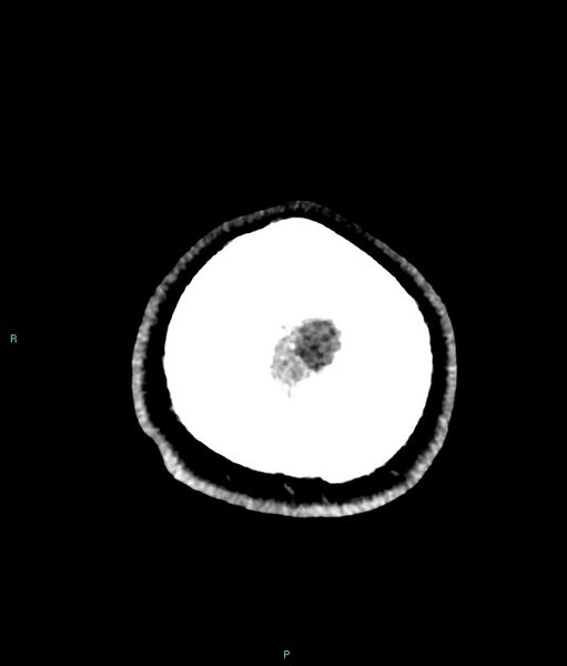 File:Calcified cerebral emboli from left ventricular thrombus (Radiopaedia 84420-99758 Axial non-contrast 6).jpg