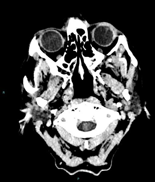 File:Calcified cerebral emboli from left ventricular thrombus (Radiopaedia 84420-99758 Axial non-contrast 88).jpg