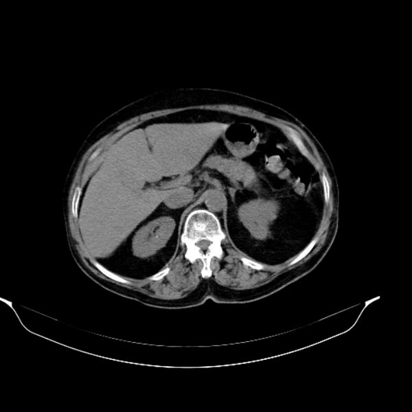 File:Calcified hydatid cyst (Radiopaedia 62000-70085 Axial non-contrast 35).jpg