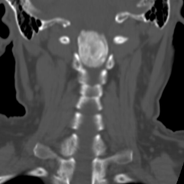 File:Calcified meningioma - cervical canal (Radiopaedia 70136-80171 Coronal bone window 20).jpg