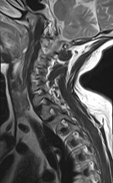 File:Calcified meningioma - cervical canal (Radiopaedia 70136-82468 Sagittal T2 5).jpg