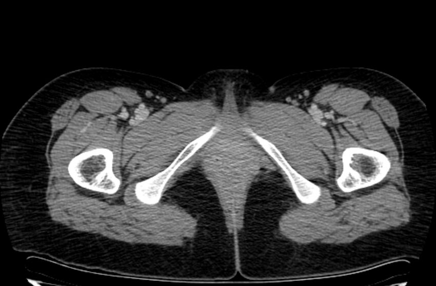 Cannonball metastases - uterine choriocarcinoma (Radiopaedia 70137-80174 A 76).jpg