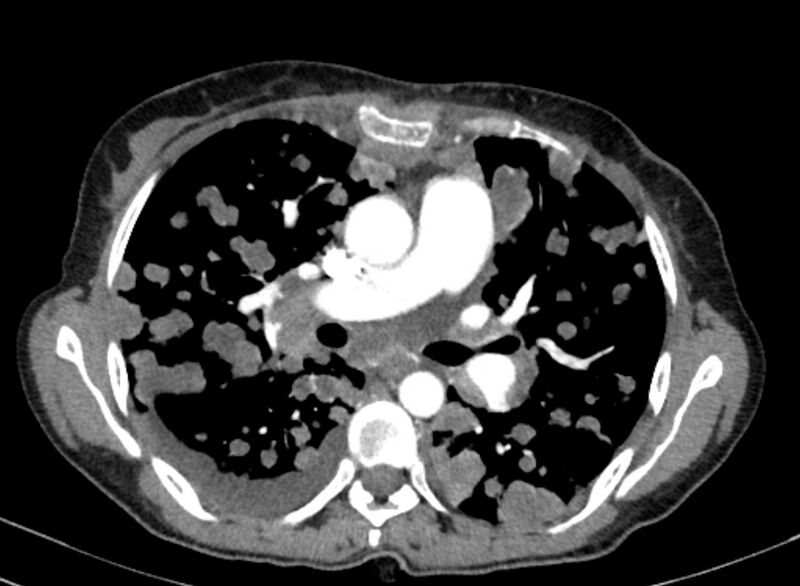 File:Cannonball metastases from breast cancer (Radiopaedia 91024-108569 A 56).jpg