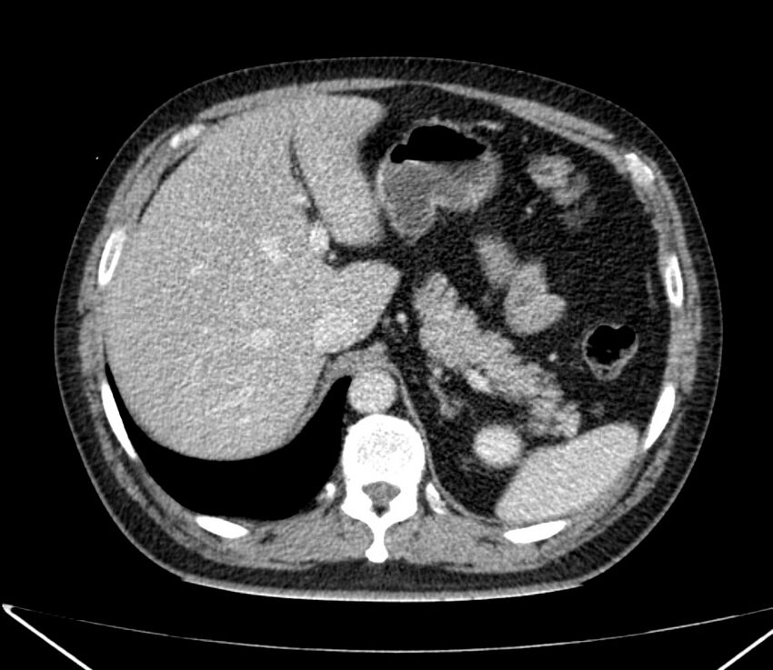 Carcinoid tumor with hepatic metastases (Radiopaedia 22651-22670 C 35).jpg