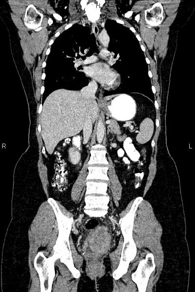 File:Carcinoma of uterine cervix (Radiopaedia 85861-101700 C 32).jpg