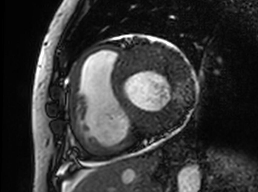 Cardiac amyloidosis (Radiopaedia 61600-69579 Short axis bSSFP 248).jpg