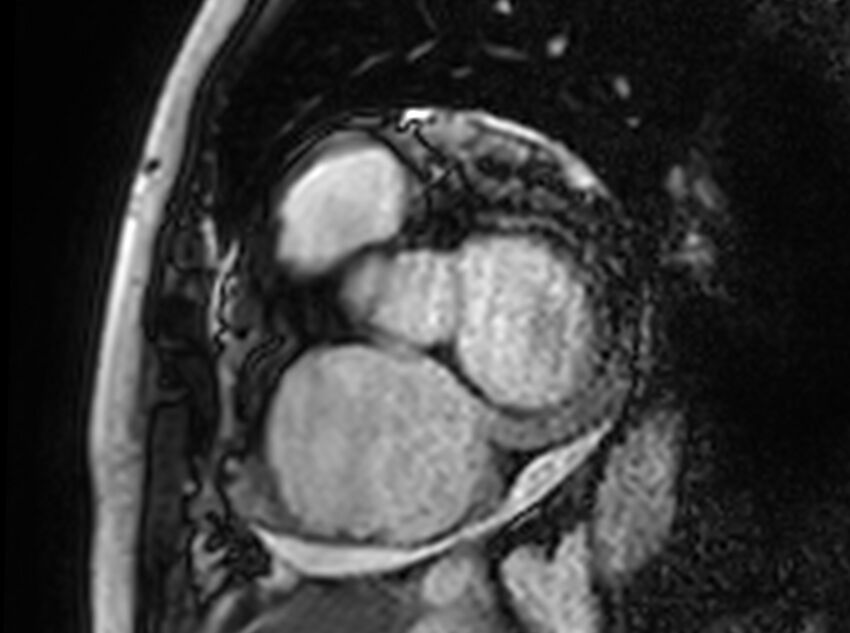 Cardiac amyloidosis (Radiopaedia 61600-69579 Short axis bSSFP 303).jpg