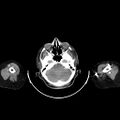 Carotid body tumor (Radiopaedia 21021-20948 A 8).jpg