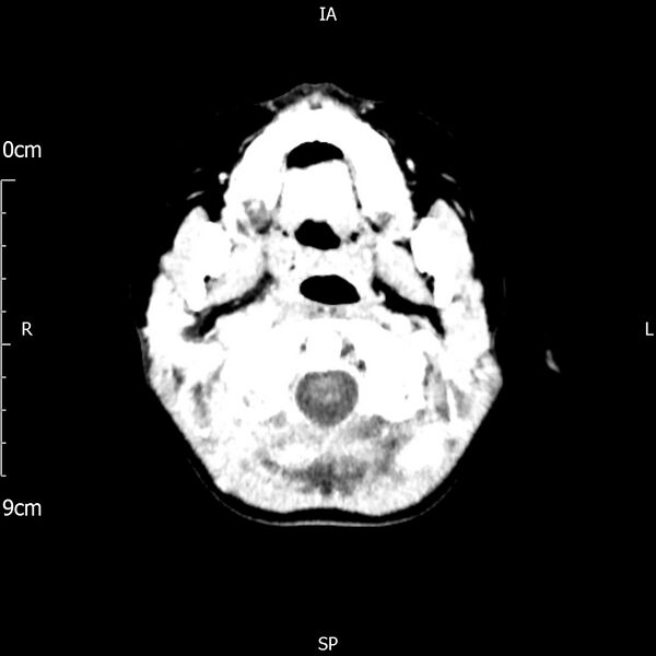 File:Cavernous sinus thrombosis (Radiopaedia 79414-92510 Axial Brain 40).jpg