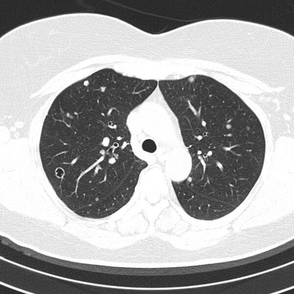 File:Cavitating pulmonary metastases (Radiopaedia 17796-17555 Axial lung window 5).jpg