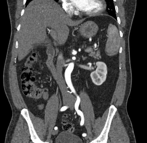 File:Celiac artery dissection (Radiopaedia 52194-58080 C 57).jpg
