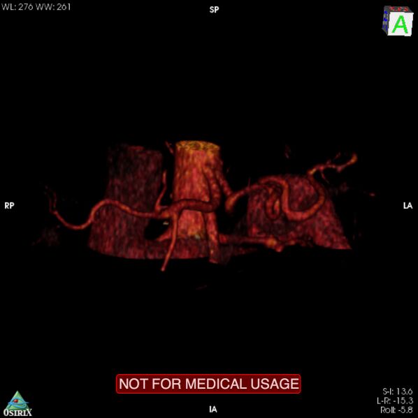 File:Celiac trunk variant anatomy - gastrohepatic trunk and splenic artery (Radiopaedia 38815-40995 B 5).jpg