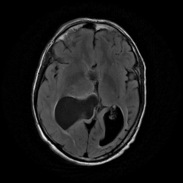 File:Central neurocytoma (Radiopaedia 67618-77021 Axial FLAIR 12).jpg
