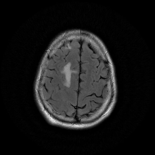 File:Central neurocytoma (Radiopaedia 67618-77021 Axial FLAIR 21).jpg