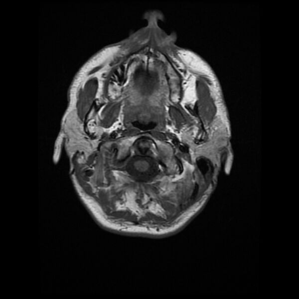 File:Central neurocytoma (Radiopaedia 67618-77021 Axial T1 2).jpg
