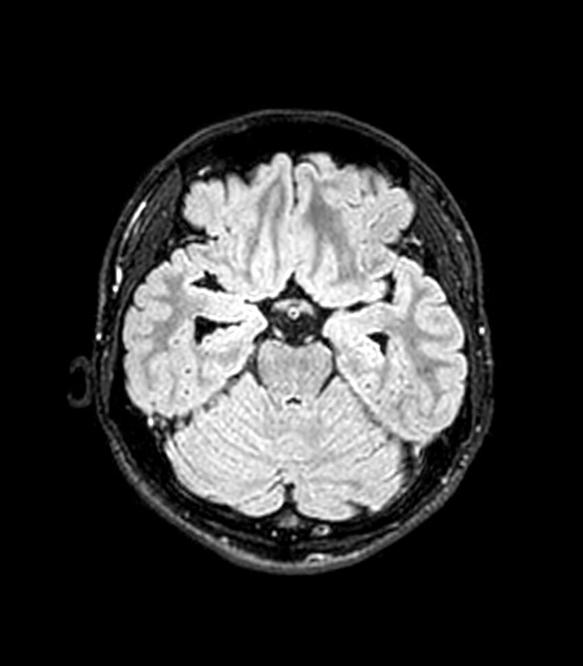 Central neurocytoma (Radiopaedia 79320-92380 Axial FLAIR 201).jpg