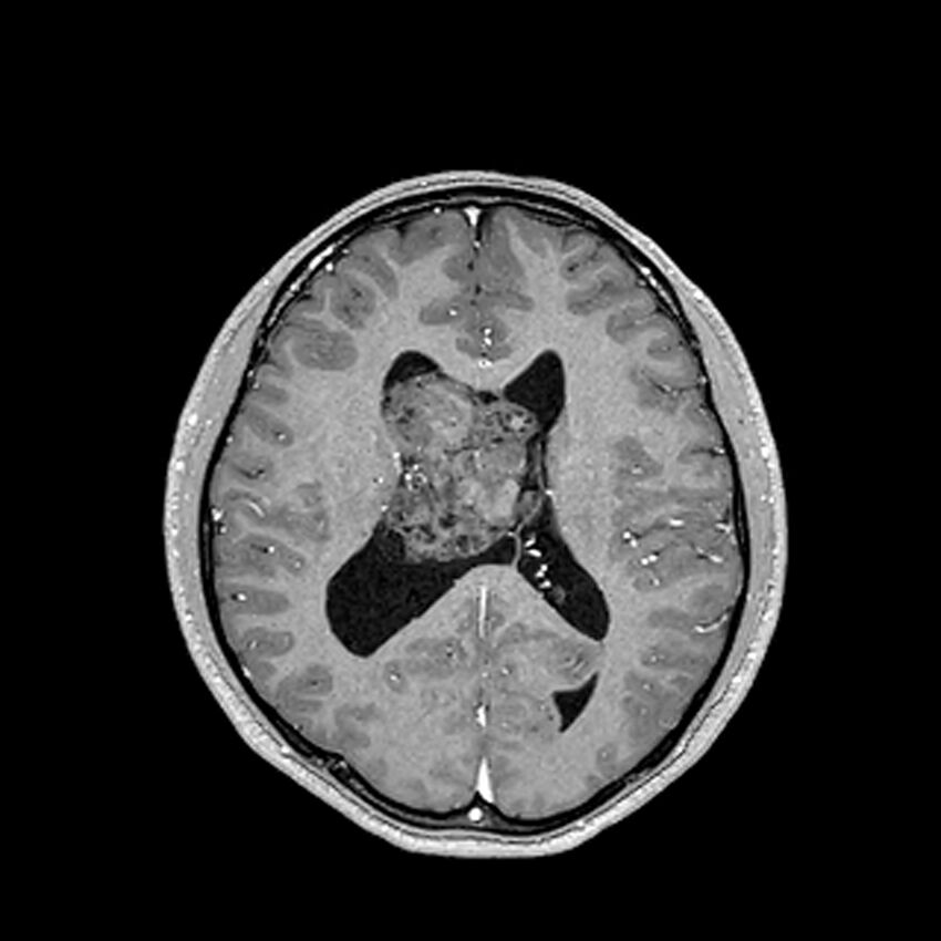 Central neurocytoma (Radiopaedia 79320-92380 Axial T1 C+ 146).jpg