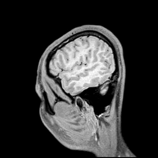 File:Central neurocytoma (Radiopaedia 79320-92380 Sagittal T1 219).jpg