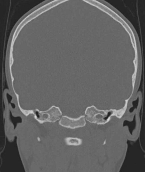 File:Cerebellar abscess (Radiopaedia 73727-84527 Coronal bone window 77).jpg