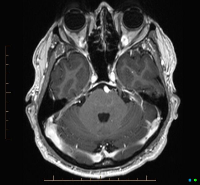 File:Cerebellar gangliocytoma (Radiopaedia 65377-74422 Axial T1 C+ 32).jpg