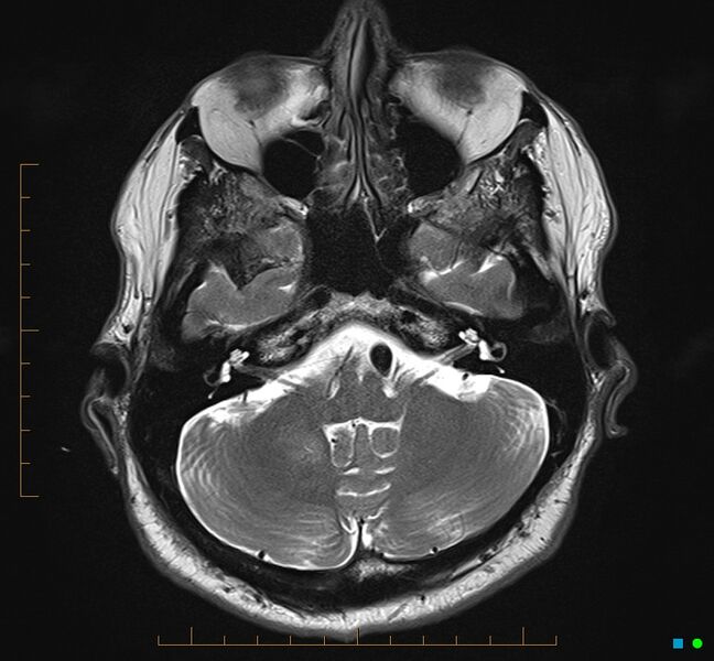 File:Cerebellar gangliocytoma (Radiopaedia 65377-74422 Axial T2 8).jpg