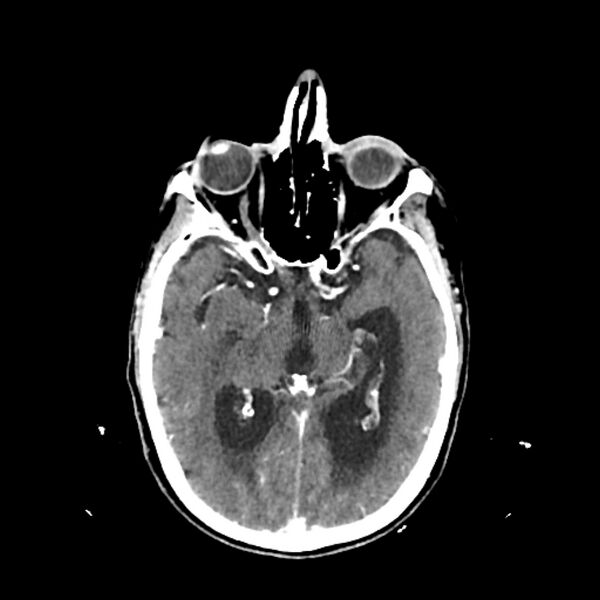 File:Cerebellar metastasis - lung tumor (Radiopaedia 69317-79145 Axial with contrast 19).jpg