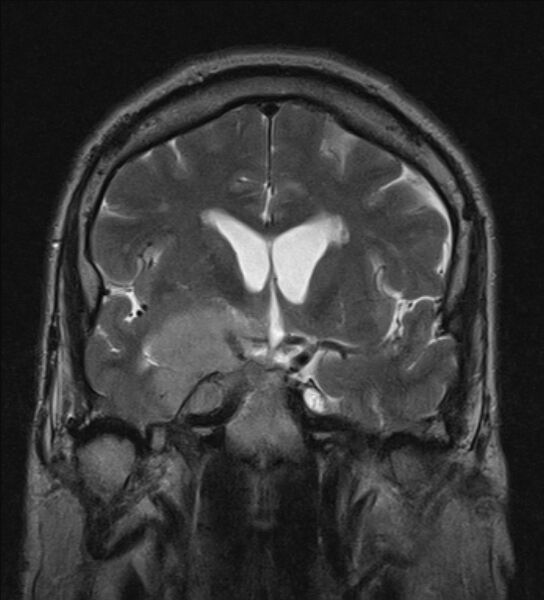 File:Cerebellopontine angle meningioma (Radiopaedia 24459-24764 Coronal T2 9).jpg
