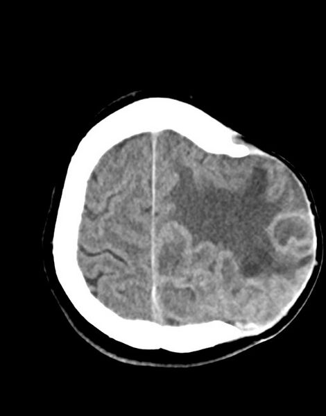 File:Cerebral abscesses (Radiopaedia 70458-80568 Axial non-contrast 50).jpg