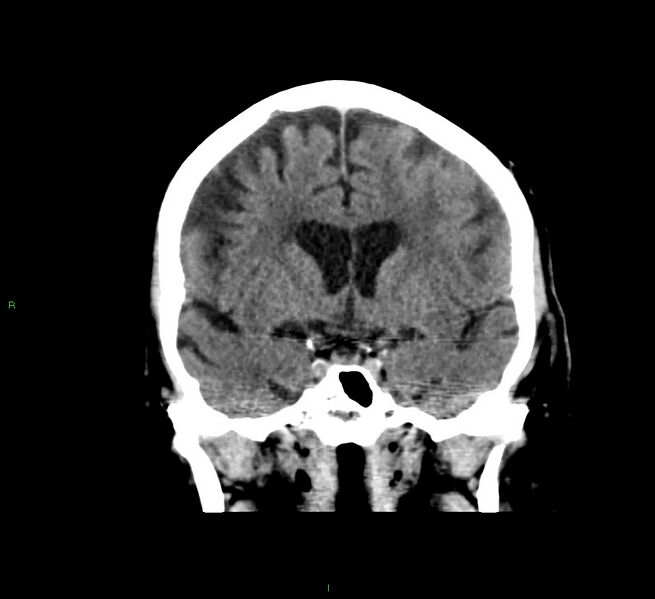 File:Cerebral amyloid angiopathy-associated lobar intracerebral hemorrhage (Radiopaedia 58376-65511 Coronal non-contrast 40).jpg