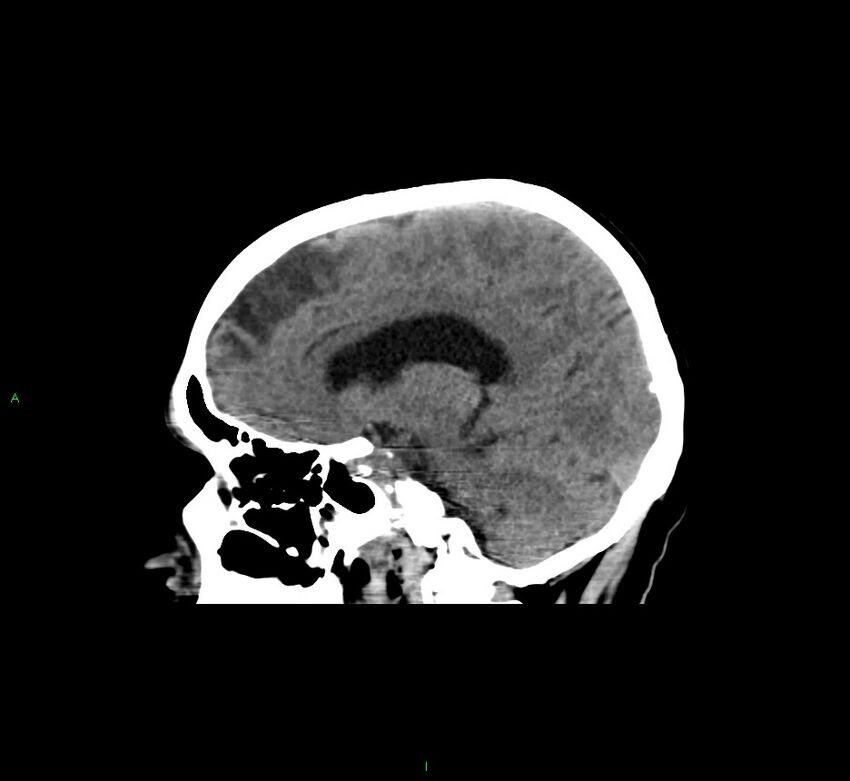 Cerebral amyloid angiopathy-associated lobar intracerebral hemorrhage (Radiopaedia 58529-65681 B 21).jpg