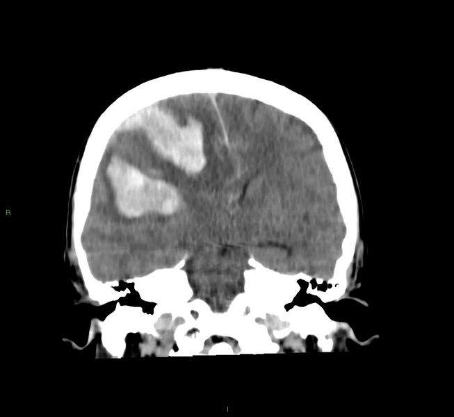File:Cerebral amyloid angiopathy-associated lobar intracerebral hemorrhage (Radiopaedia 58756-65977 Coronal non-contrast 35).jpg