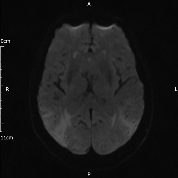 File:Cerebral amyloid angiopathy related inflammation (Radiopaedia 72772-83415 Axial DWI 36).jpg
