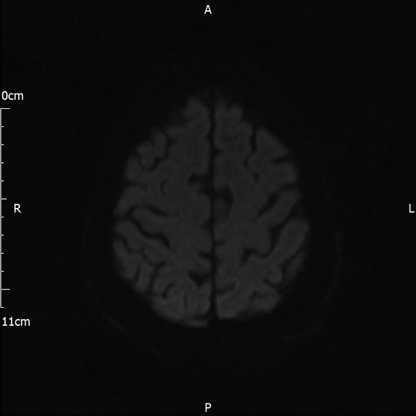 File:Cerebral amyloid angiopathy related inflammation (Radiopaedia 72772-83415 Axial DWI 65).jpg