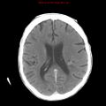 Cerebral and orbital tuberculomas (Radiopaedia 13308-13310 B 18).jpg