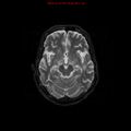 Cerebral and orbital tuberculomas (Radiopaedia 13308-13311 Axial T2 9).jpg