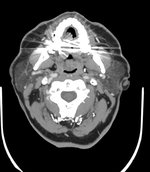 File:Cerebral dural venous sinus thrombosis (Radiopaedia 86514-102576 A 12).jpg